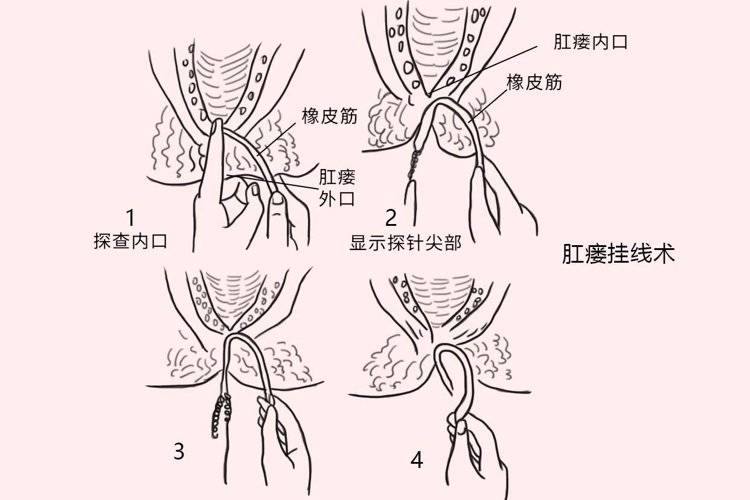 肛瘘手术最新技术探索，前沿进步与手术治疗发展